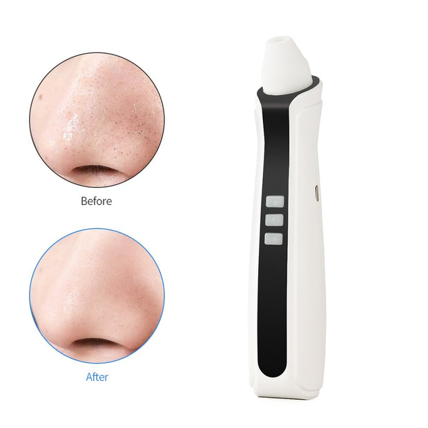 Visual Blackhead Vacuum Suction with Microscope Camera