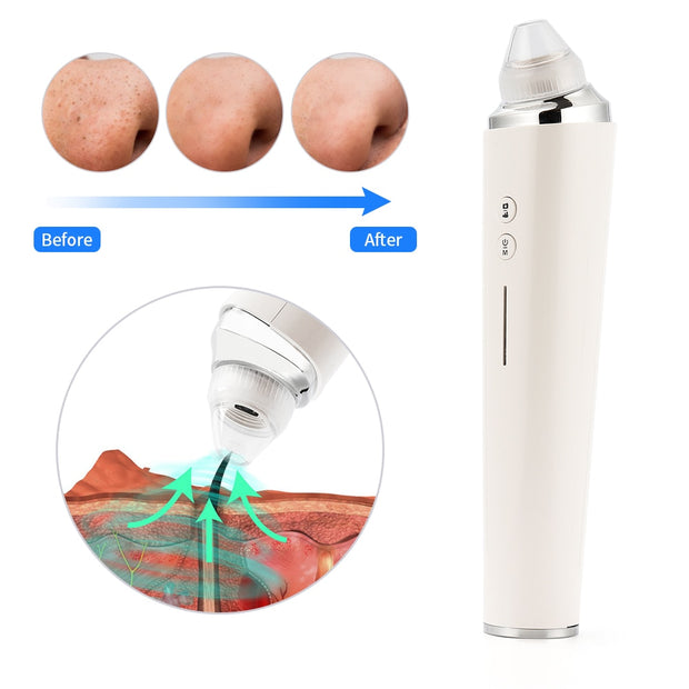Visual Blackhead Vacuum Suction with Microscope Camera